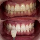 석치과의원 | 구미 석치과의원) 치아미백 할인이벤트중이라고?!