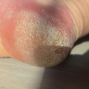 웰빙헬스팜 | 고은발 크림 갈라진 발뒤꿈치 보습력 솔직 사용 후기