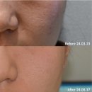 청담도트의원 | 강서구발산역마곡역피부과 쥬베룩 볼륨 한병의 기적 여드름 흉터 모공 미간주름 관자 이마 볼륨 팔자...