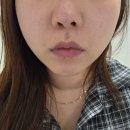 펫미인 | 거울 볼 때마다 스트레스였던 이중턱 양산피부과 얼굴제로팻 1회차 솔직 후기 통증 및 부작용