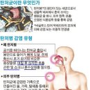 뉴욕타임스, 정부에 대한 불신, 메르스 공포 확산의 주범 - 탄저균 감염 증세, 탄저병 증상 이미지