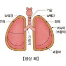 ﻿이물질에 의한 기도막힘 (Airway obstruction) 이미지