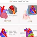 심부전 원인 이미지