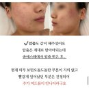 연세비비에스테틱 | 천안 압출 잘하는 곳, 솔에스떼 체험단 이후 내돈내산으로 방문 후기 및 전후 비교샷