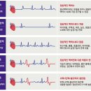 질병 "부정맥 arrhythmia" 이미지