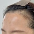 오즈헤어라인 이미지
