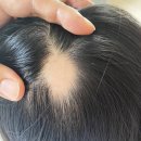 동수김원호내과의원 | 부평역피부과 원형탈모, “숨겨진 진실” 아무도 몰랐던 그 사실을 공개합니다.