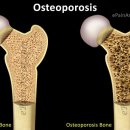 골다공증[osteoporosis]질환이란? 이미지