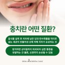 송도동 충치 치료 치과마다 갯수 다른 이유는?