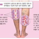 하지정맥류의 치료와 예방 이미지