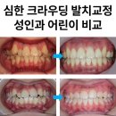 현대PLUS치과의원 | 강동구 교정치과, 치아교정 시작 시기. 심한 비뚤함 발치교정 후기로 보는 성인과 어린이 비교