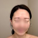 아랑스킨테라피 | [얼굴작아지는법] 국내최초 발사지 전문 100% 책임관리제 위뷰티 만족후기
