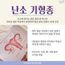 (주)몸부림 | [난소기형종 수술 후기] 복강경 수술은 얼마나 아플까