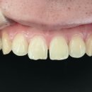 엠에스탑치과의원 | 앞니 벌어짐 한방에 해결~! 이렇게 예쁘게 된다고? (다이에스테마, Diastema)