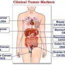 암 치료 과정에서 암 표지자 검사의 문제점; 특히 CA-19-9에 관하여 이미지