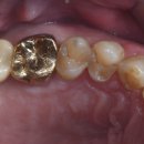 경우 | 당일 임플란트 어금니 발치 즉시 식립 가능한 경우, 후기