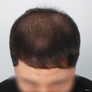 디에스가발 | 수원 남자 정수리 탈모 고민 해결 후기