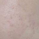 허튼소리 | 얼굴잡티제거 내돈내산후기