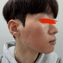 그린피부과의원 | 스노우의원 방문기 2편 1회차 시술 시크릿레이저, NMN 약물침투, LED 재생 레이저, 리페어크림 피부과