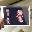 🍼👣임신 8W~12W : 난임병원 졸업•분만병원 전원•임신 초기 증상•태아보험 가입•1차 기형아 검사...
