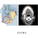 타석증 (Sialolithiasis) 이란? 이미지