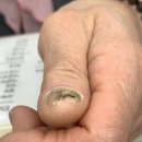 동성의료기 | 안양손톱무좀 문제성손톱 케어 후기 미엘네일 동성제약 풀리메디 범계점
