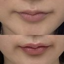 소마1 | 아트먼트모네 입술교정 1회차 내돈내산 후기｜소마쌤, 신사동 가로수길