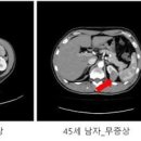 신장암 신장암 병기 1기 2기 3기 4기 신장암 원인 신장암 옆구리 통증 이미지