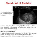 Blood clot of Bladder 이미지