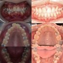 연세고운미소치과의원 | [연세고운미소치과강동점]발치를 통한 돌출입 해결 및 외모 개선