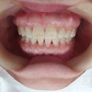 연세더편한치과의원 | 🦷 정기검진을 받으면, 실제로 뭐가 달라질까요?| 우면동°양재°과천 연세더편한치과