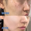 참바른약국 | 약국 피부재생크림 레이저 후 재생크림 이게 최고 ^^