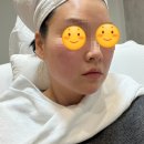달채 | 한남역피피부과 채올리프팅 한달 후기 모공 팔자주름 전후 변화