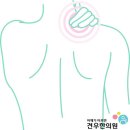 홍대한의원 석회성건염 원인과 치료 이미지