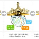 [척추관절, 척추디스크, 허리디스크, 재활운동]정상 디스크와 수핵 탈출 이미지