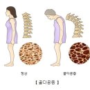 골다공증 (Osteoporosis)원인과 치료 이미지