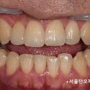 최강치과기공소 네이버블로그