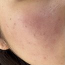 멍# | 부산 리투오 양산 피부과 후기 통증 멍 리쥬란비교