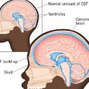 뇌수두증 원인 및 치료 수술 (뇌수종, 물뇌증, 션트, 뇌압상승 증상) 이미지