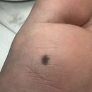 주덕성모외과의원 | 건대성모외과의원 발바닥 점제거 비용 및 실비청구 후기(내돈내산)