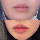 필러 스튜디오 | 부산입술필러 서면입술보톡스 내돈내산으로 한 후기 3주 경과