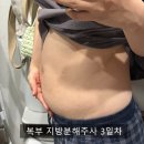 하얀멍이 | 복부 지방분해주사 시술 용량 및 부작용 1회차 후기