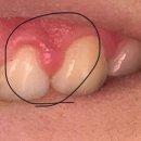 다인치과병원 | 잇몸이 무너지면 온몸이 무너진다… 치은염 극복한 구강유산균 후기(노르다인)