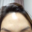 좁쌀여드름 같은 이마 편평사마귀, 재발 없이 없애는 방법