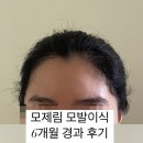 모제림외과의원 | [모제림 성형외과] 헤어라인 모발이식 6개월차 후기 l 헤어라인, 수술후기 l 모발이식 수술 주의사항