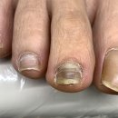 한국레이져메디칼 | 안양 인덕원 발톱무좀 미엘네일 동성제약 풀리메디 범계점 방문 후기