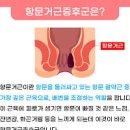 항문거근증후군 및 (엉덩이 항문 통증, 잔변감) 이미지