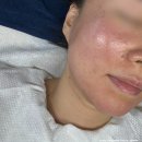 마산여드름관리 조엘랑더마랩 대만족 후기