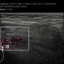 axillary lymphadenitis(액와부 림프절염) 이미지