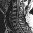 l-spine mri 이미지